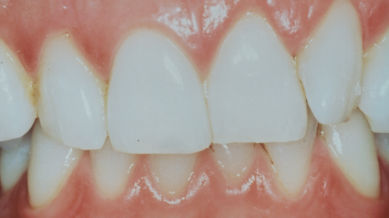 bleaching_1_nachher
