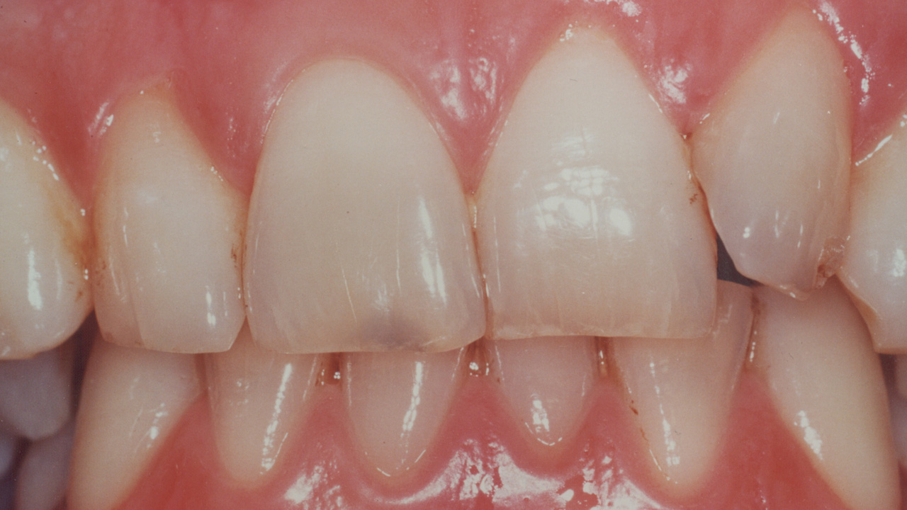 bleaching_1_vorher