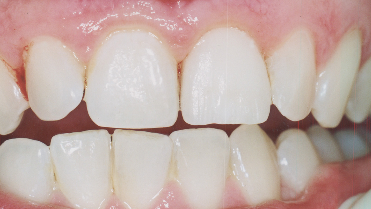 bleaching_veneer_nachher