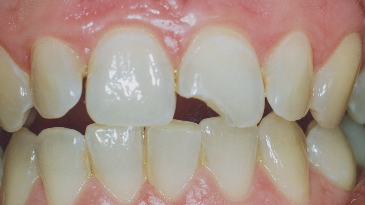 bleaching_veneer_vorher