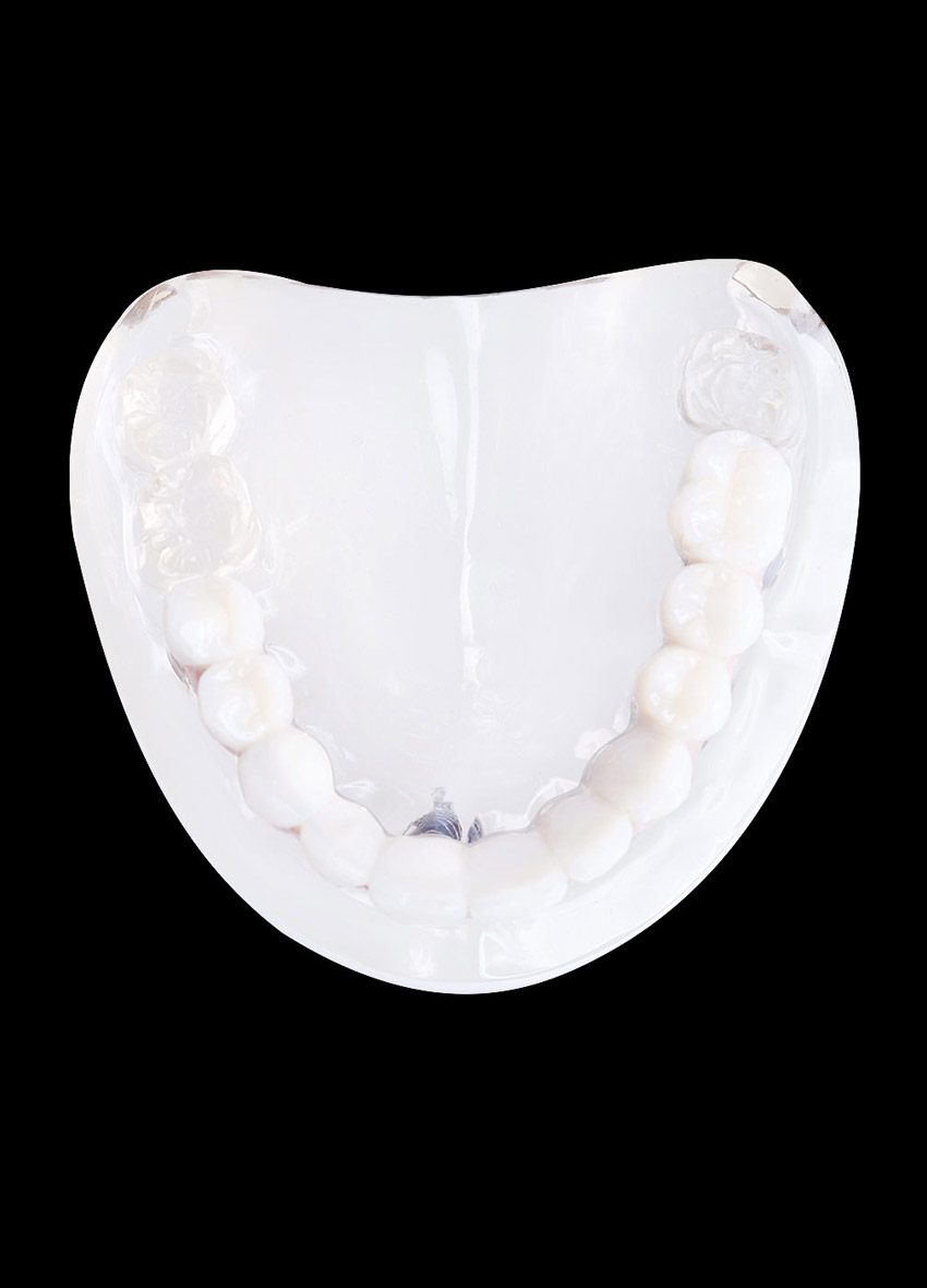 festsitzende-implantatversorgung-2-mobile-header