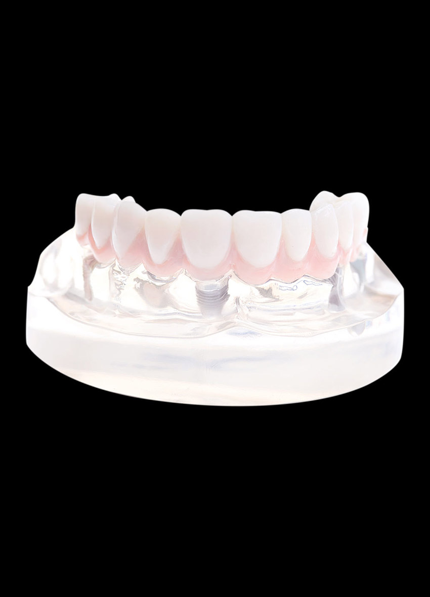 festsitzende-implantatversorgung-3-mobile-header