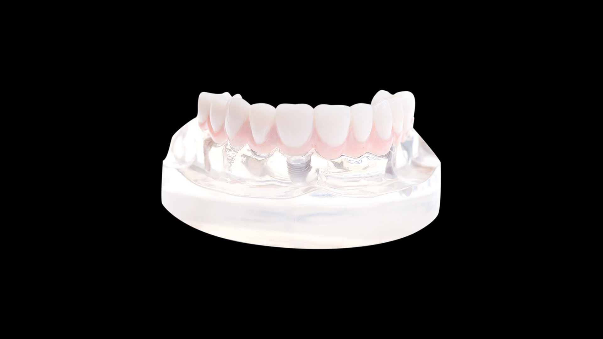 festsitzende-implantatversorgung-3