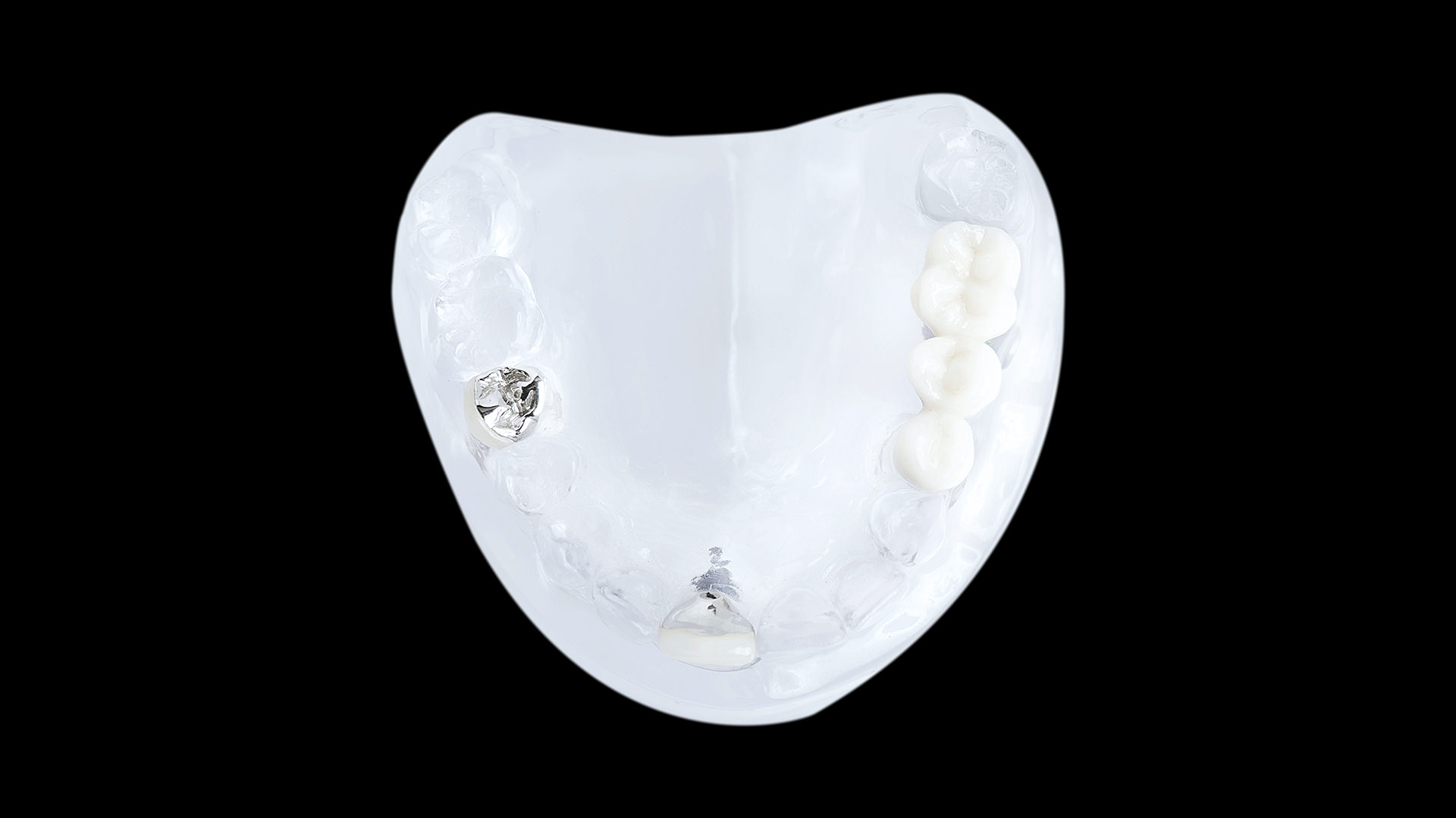 implantatbruecke-2