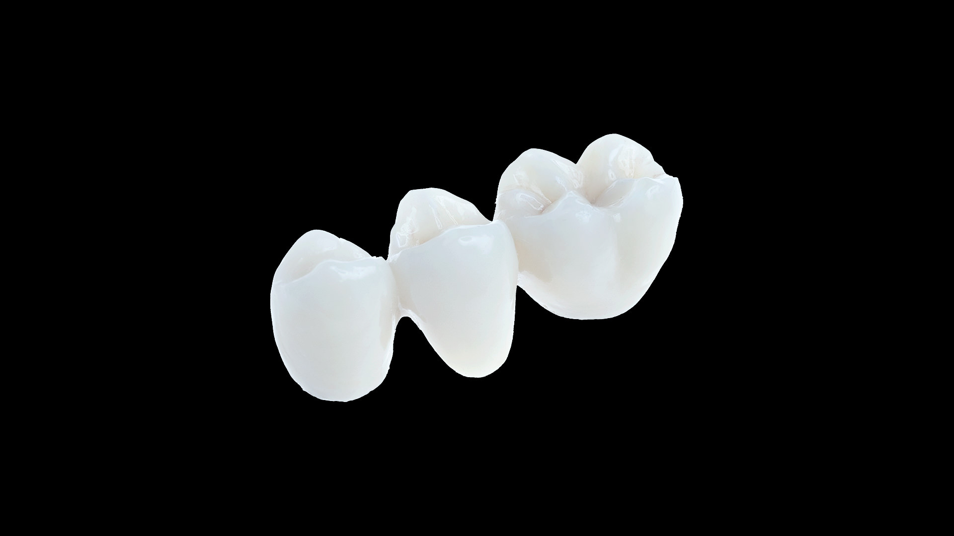 implantatbruecke-3
