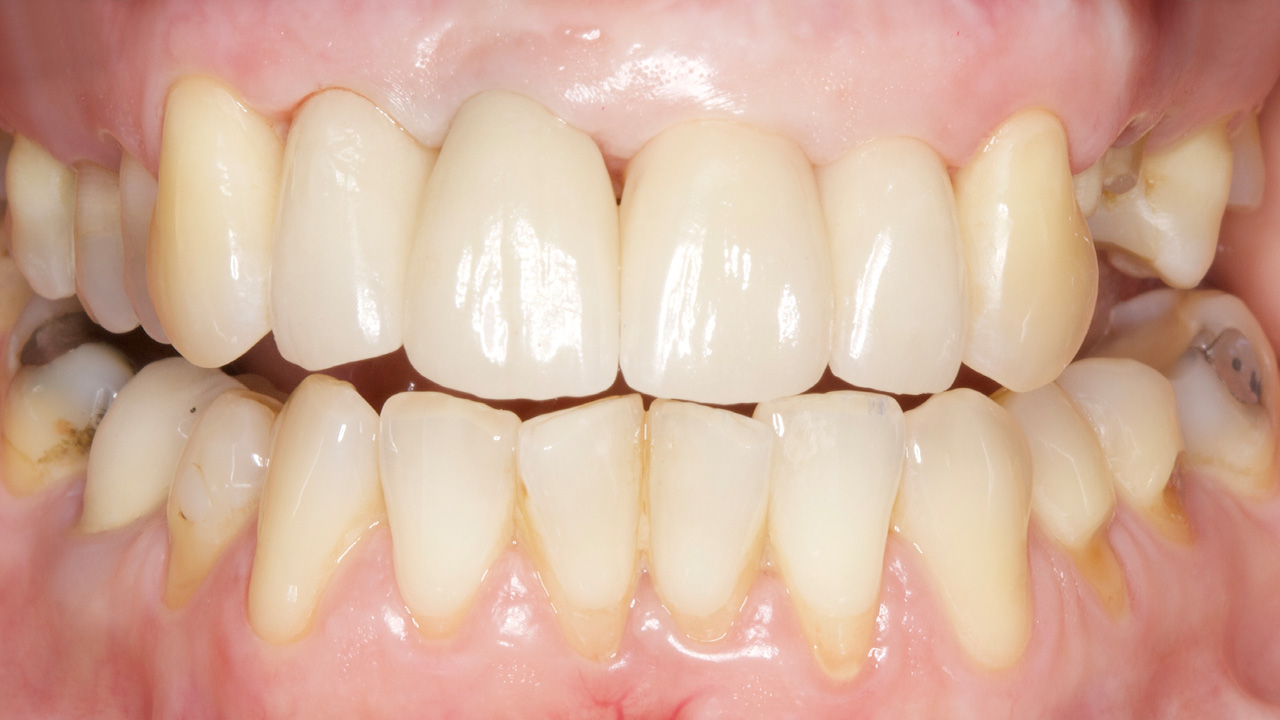 implantate_1_nachher
