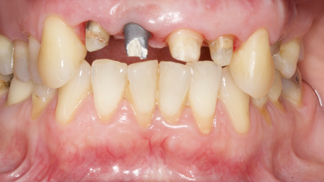 implantate_1_vorher